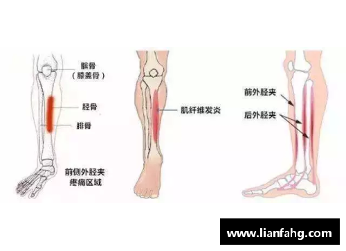 体育明星中哪些曾经历胫骨平台骨折及其恢复过程